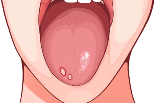 bercak putih di lidah