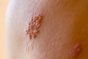 herpes genital