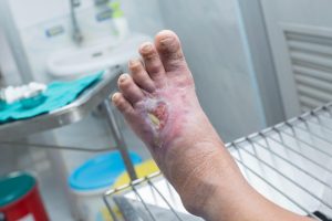kaki diabetes